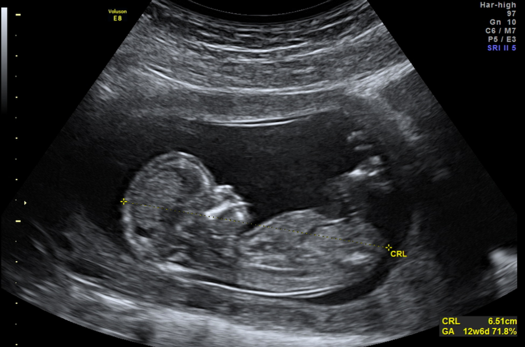 Узи ребенка на 13 неделе. 12 Недель беременности фото плода на УЗИ. УЗИ на 14-15 недели беременности пол ребенка. УЗИ 13 недель беременности мальчик. Снимок УЗИ на 12 неделе беременности.