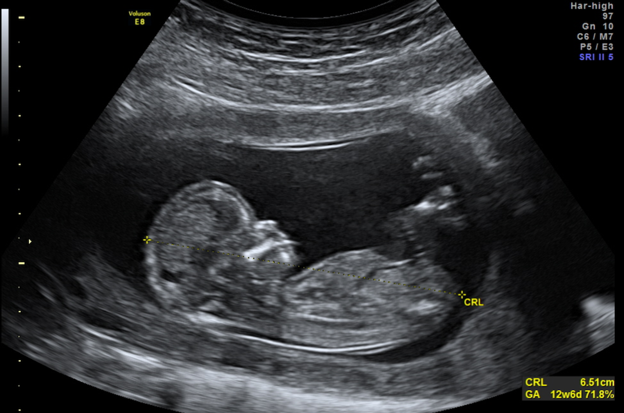 12 Недель беременности фото плода на УЗИ. УЗИ на 14-15 недели беременности пол ребенка. Фото скрининга на 12 неделе беременности. Скрининг 14 недель беременности фото УЗИ. 0 12 недель